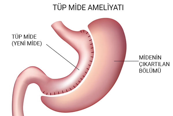 Tüp Mide Ameliyatı