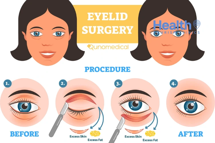 Can Blepharoplasty Be Done Under Local Anesthesia