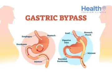 Can Gastric Bypass Surgery Be Reversed?