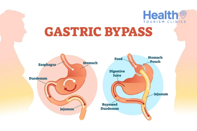 Can Gastric Bypass Surgery Be Reversed?