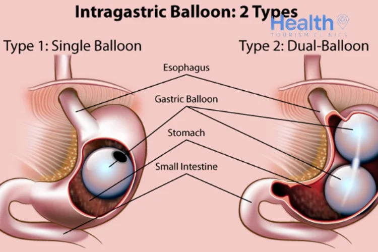 How Gastric Balloons Work