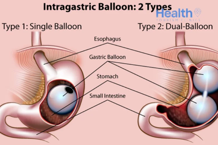Cum funcționează baloanele gastrice