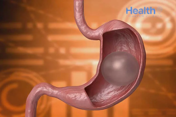 Are Gastric Balloons Effective?