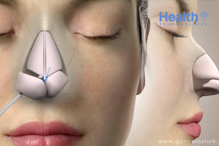 Rhinoplasty for Breathing