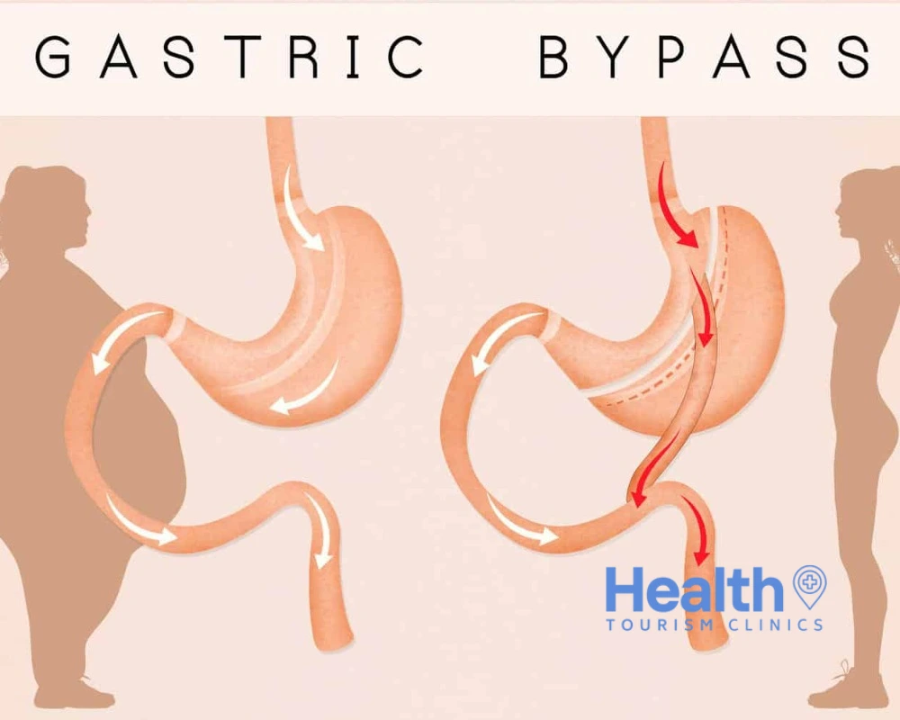 Can I Reverse Gastric Bypass?