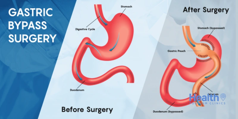 A cirurgia de bypass do estômago pode ser revertida?