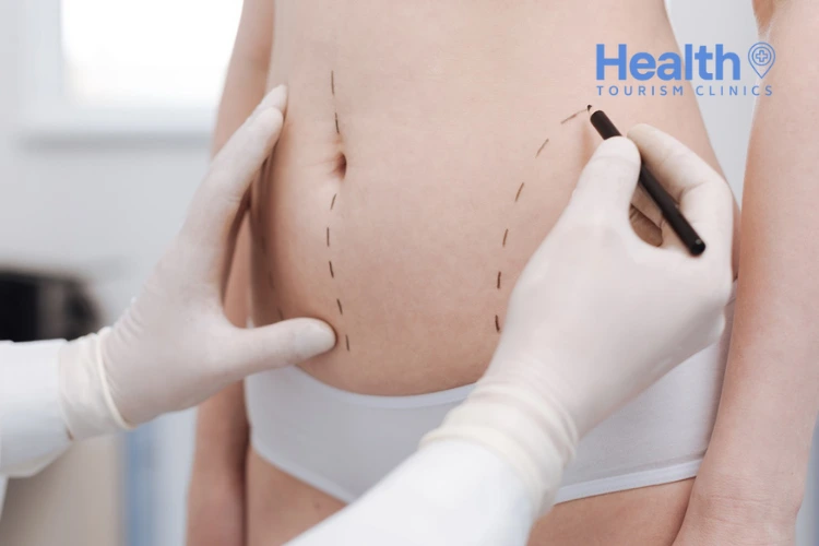 The Role of Liposuction in Cellulite Treatment