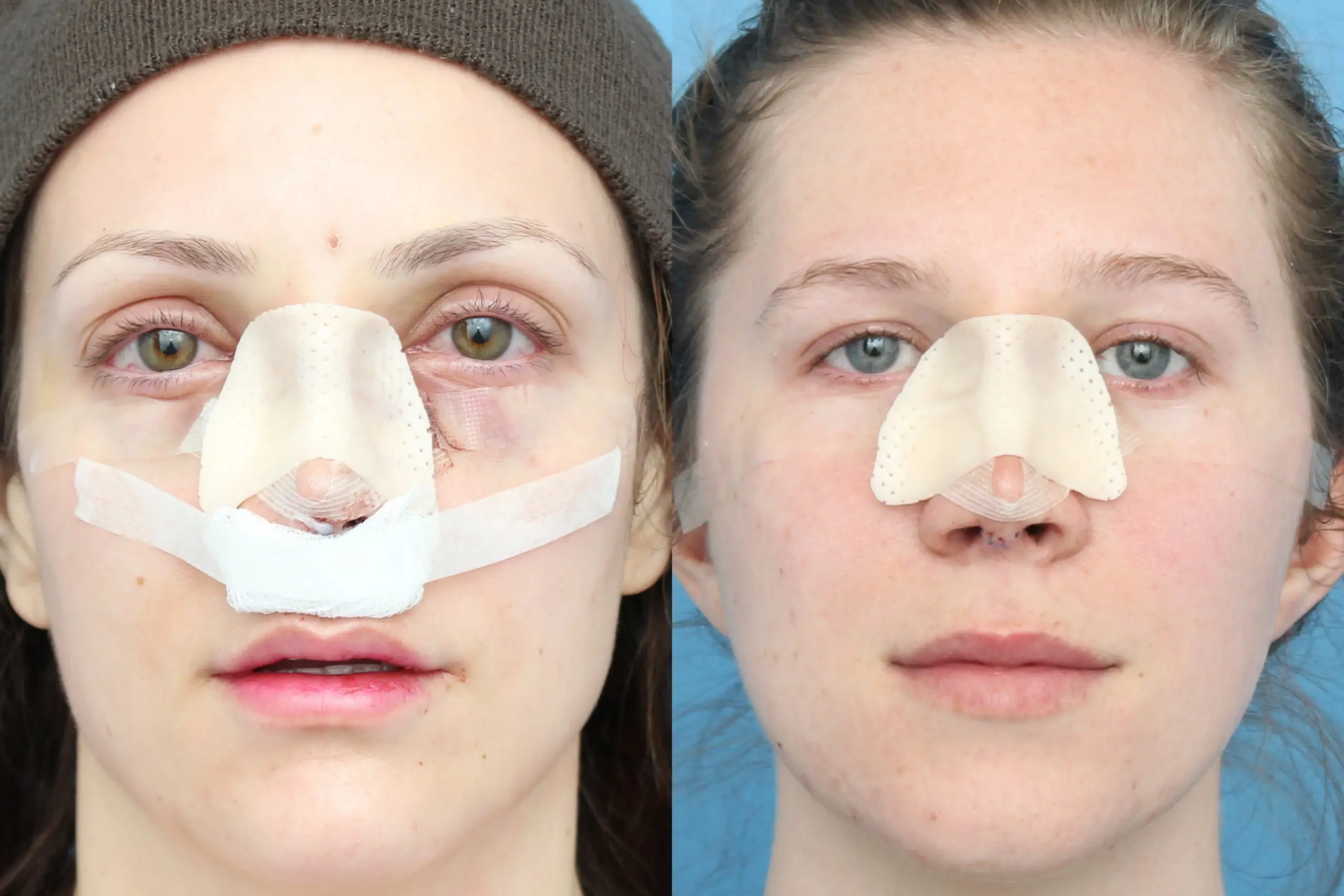 Rhinoplasty How To Reduce Swelling