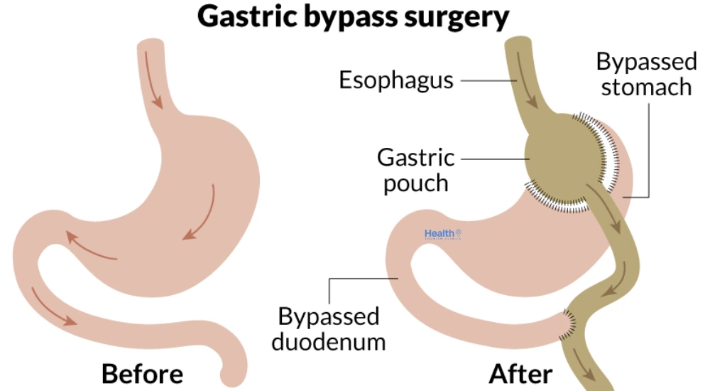 Can You Redo Gastric Bypass Surgery?