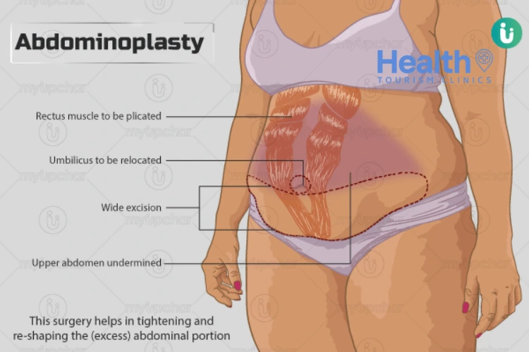 Abdominoplasty (Tummy Tuck)