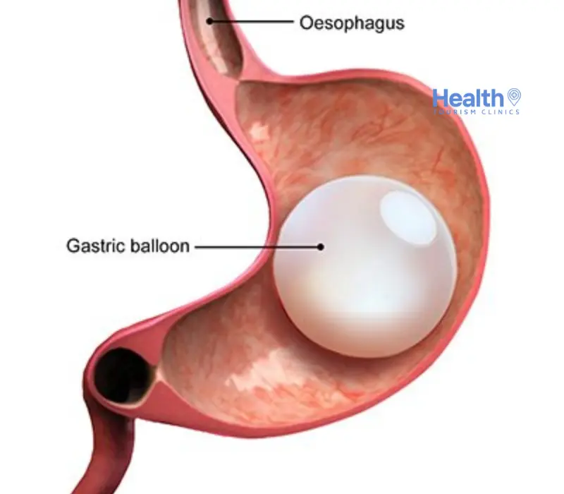 Inona no atao hoe balaonina gastric ary ahoana no ampidirana azy?