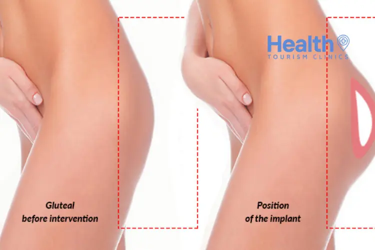 Butt Augmentation (BBL) in Istanbul