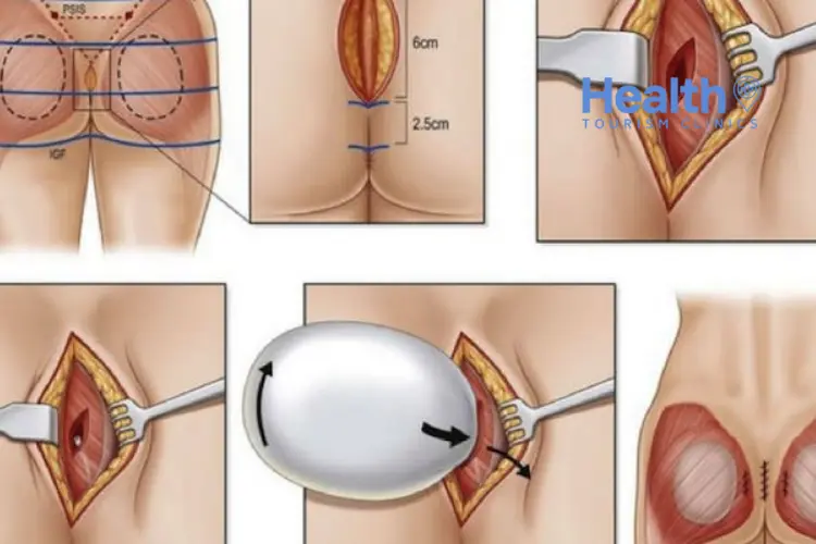 What Is Butt Augmentation (BBL) Surgery and How Is It Done?