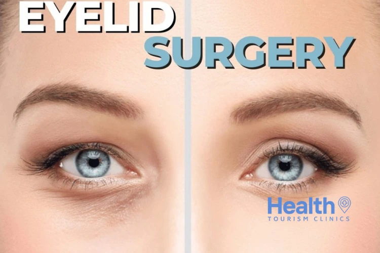 Eyelid Surgery in Turkey – 2023 Price & Review Clinics