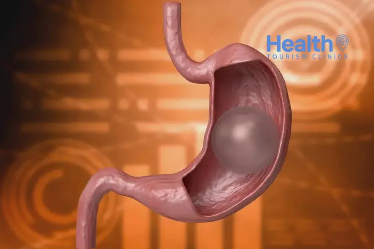Gastric Balloon in Turkey – 2023 Price & Review Clinics