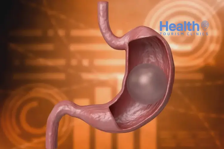 Gastric Balloon in Turkey – 2024 Price & Review Clinics