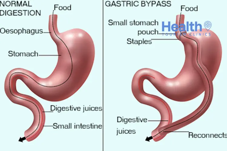What Is Gastric Bypass Surgery and How Is It Performed?