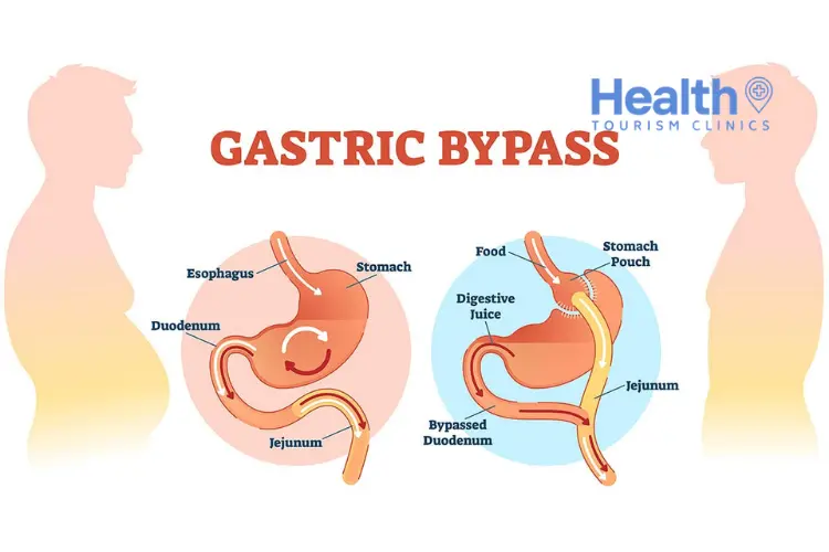 Gastric Bypass in Turkey – 2023 Price & Review Clinics