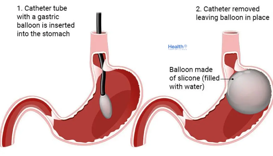 What Is a 12-Month Gastric Balloon?