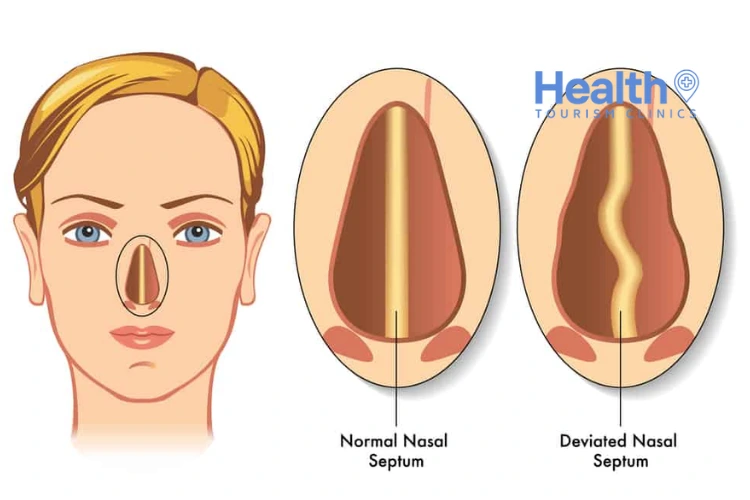 Septorhinoplasty in Turkey – 2023 Price & Review Clinics