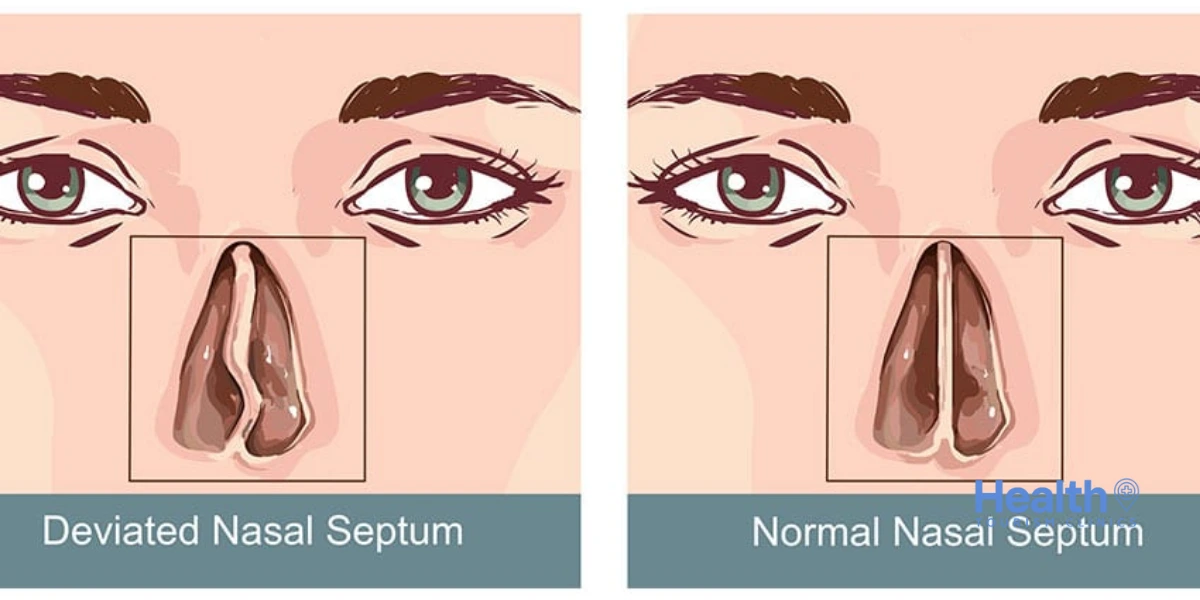 The Septorhinoplasty Procedure