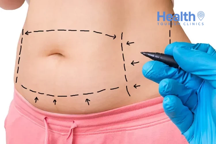 What Is a Abdominoplasty Surgery and How Is It Performed?