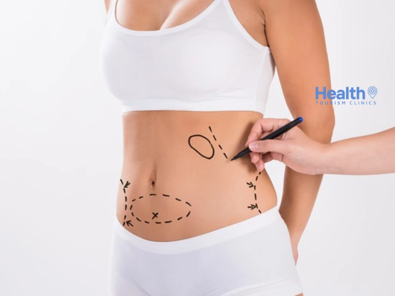 Liposuction in Antalya