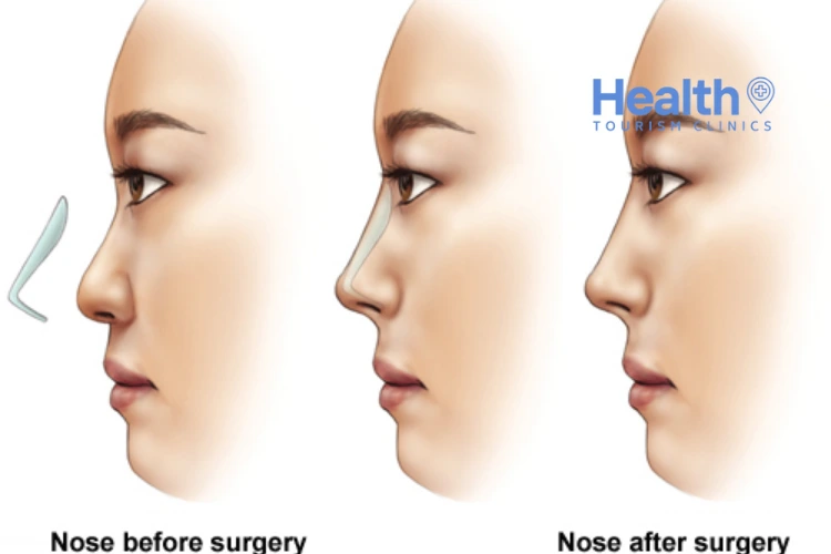Finding the Best Rhinoplasty Surgeon in Istanbul