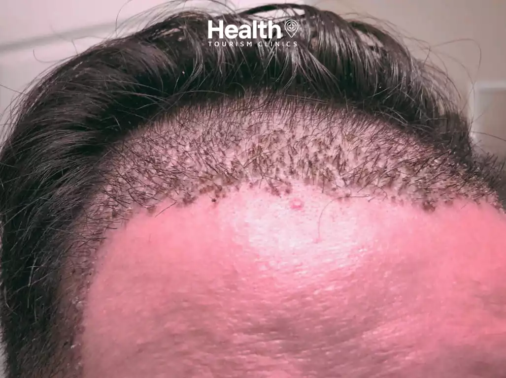 Hair Loss Start After Hair Transplant?