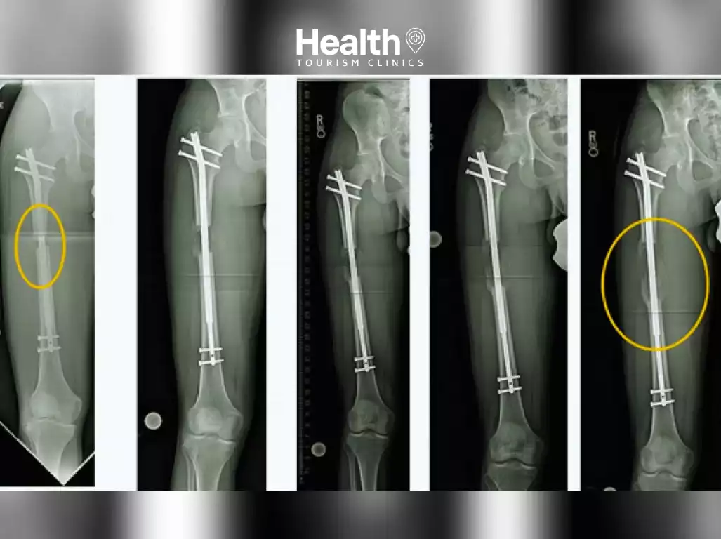 Limb Lengthening