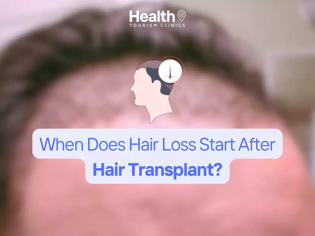 When Does Hair Loss Start After Hair Transplant?