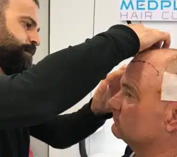 medplus hair clinic turkey 0