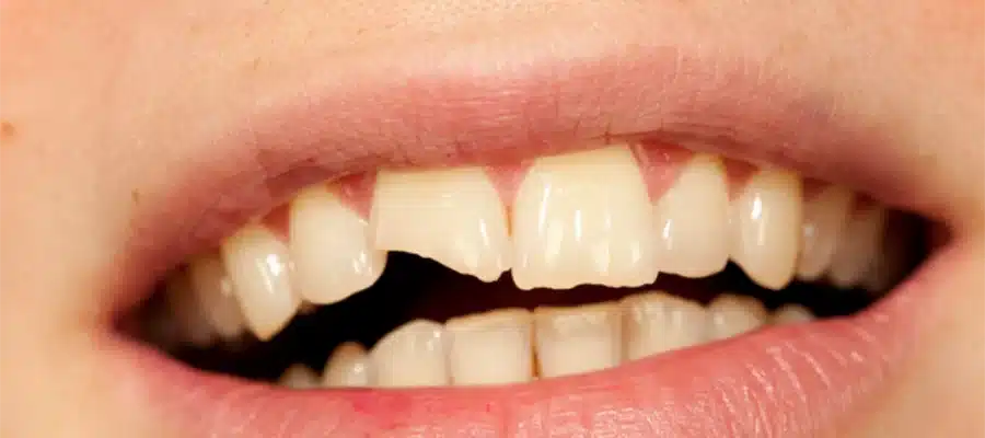 Hollywood Smile Sonrası Dişler Kırılır Mı?