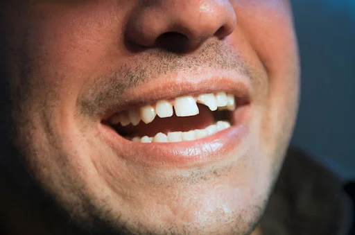 Hollywood Smile Sonrası Dişlerde Kırılma Olur Mu?