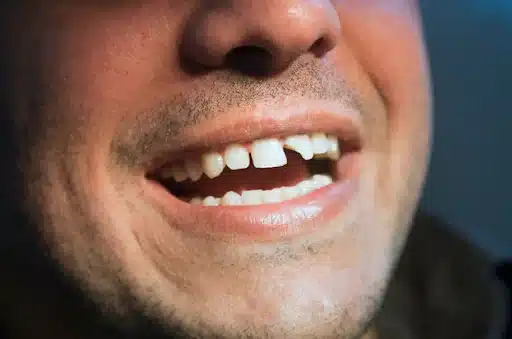 Hollywood Smile Sonrası Dişlerde Kırılma Olur Mu?