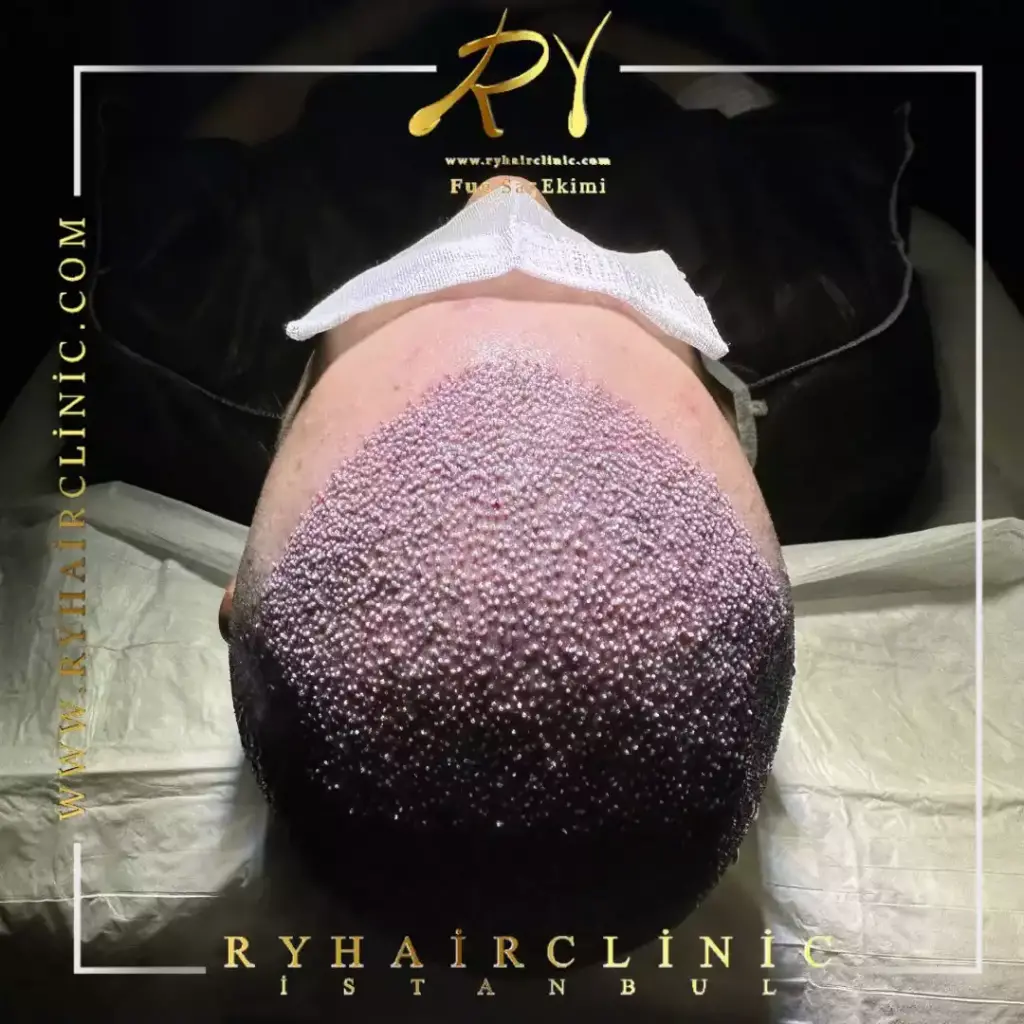 ry hair clinic (4)