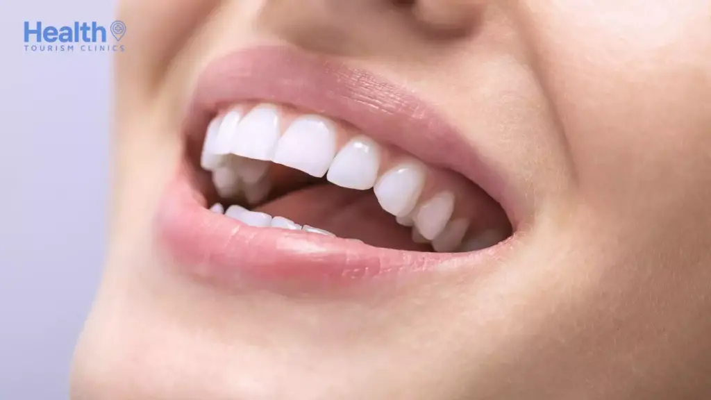 Hollywood Smile Sonrası Diş Beyazlığı