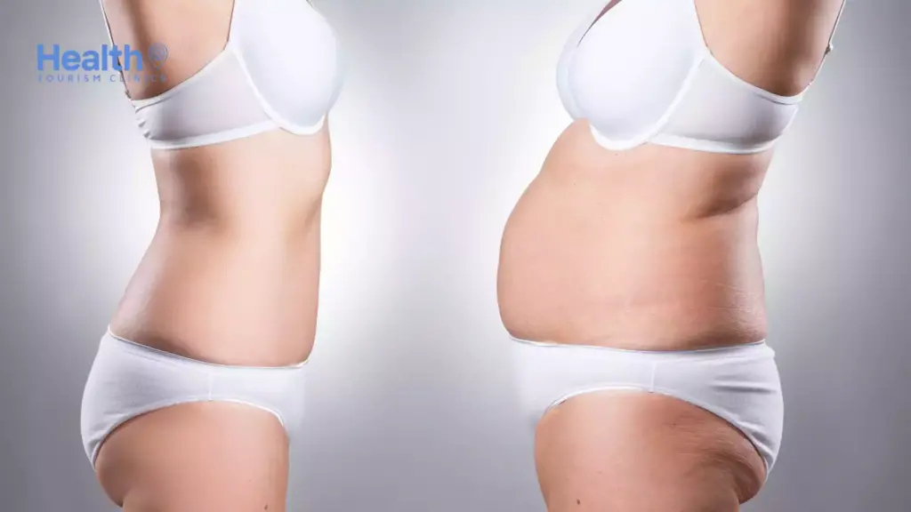 Liposuction Estetiği Öncesi Detaylar