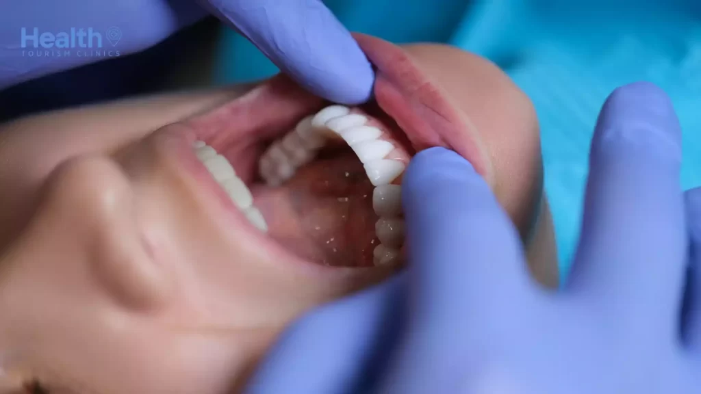 Zirkonyum Diş Tedavisi Hakkında Sık Sorulan Sorular