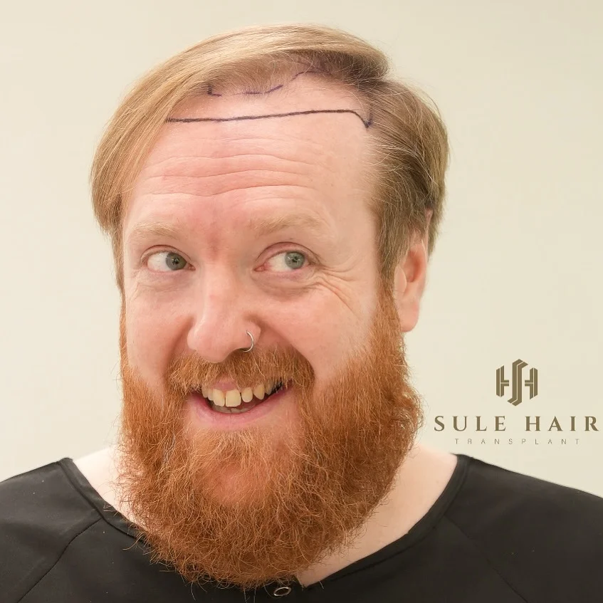 sule hair transplant man