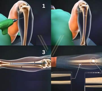 limb-lengthening-in-turkey-surgery