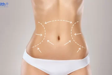 How Much is Liposuction in Turkey? (Best Clinics 2025)