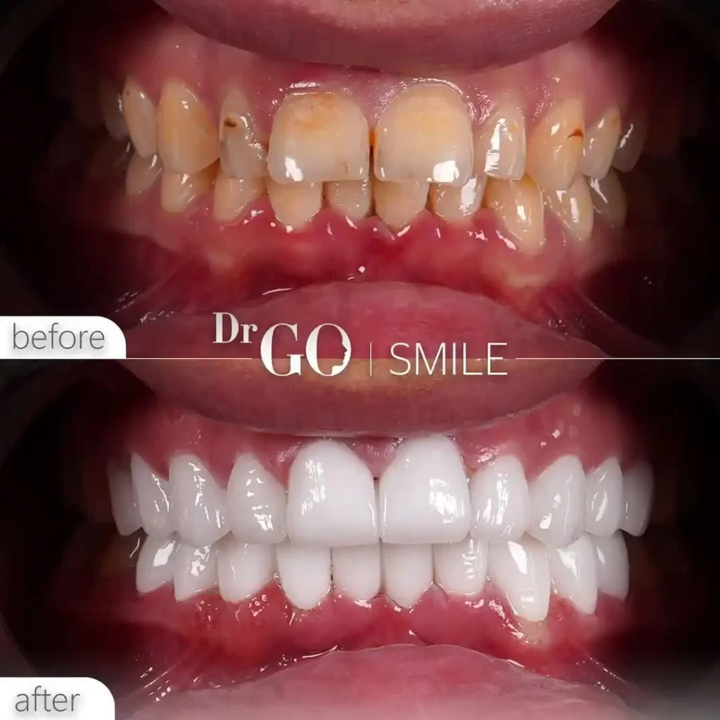 DrGO Smile Dental Implant