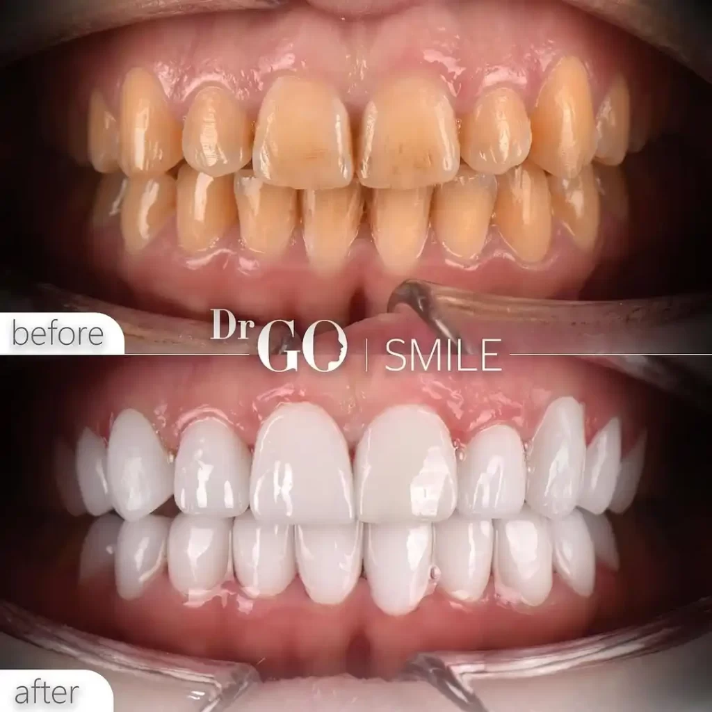 DrGO Smile Hollywood Smile
